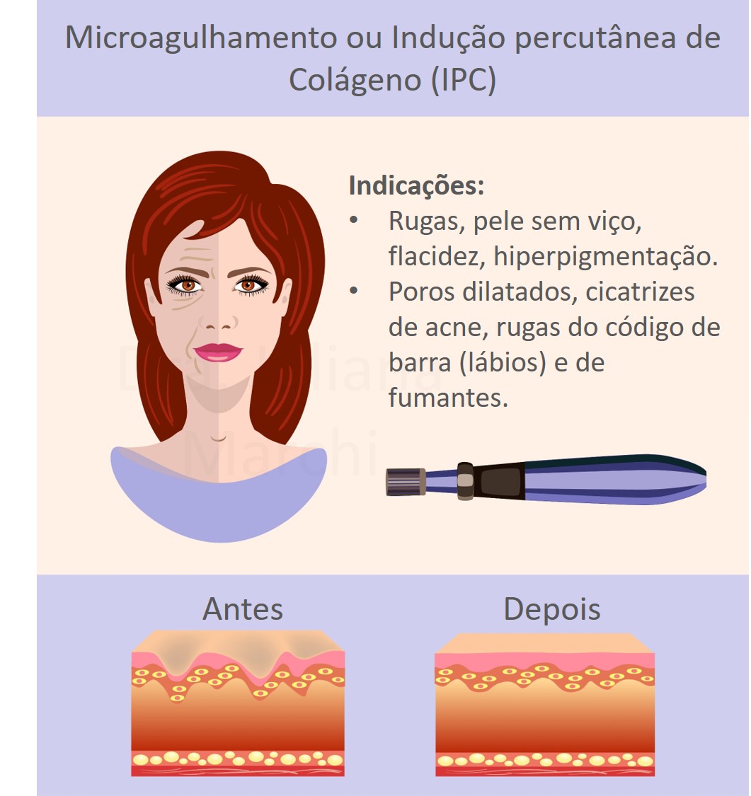 O que saber antes de aplicar o MICROAGULHAMENTO. 